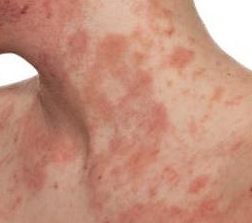 Dermatitis atópica 2